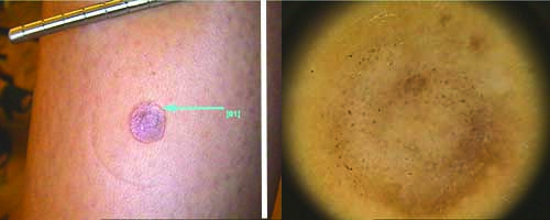  Melanoma Amelanotico 