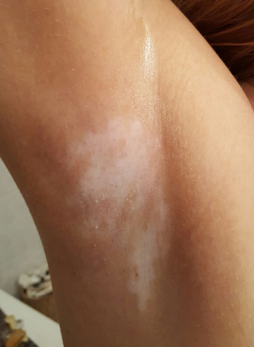 prima della terapia