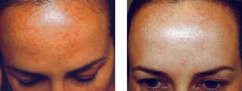 HYPERPIGMENTATION