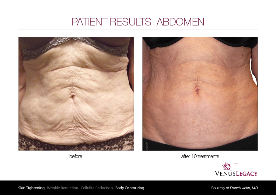 VLE__Before&After_010 (1).jpg