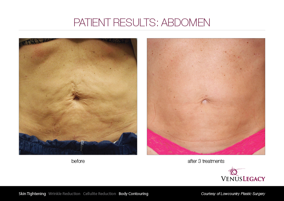 VLE__Before&After_011 (1).jpg