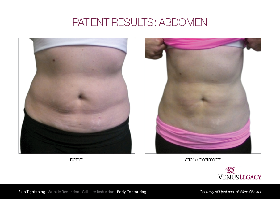 VLE__Before&After_016 (1).jpg