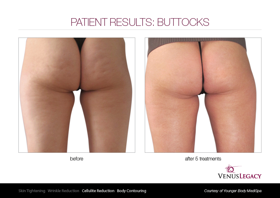 VLE__Before&After_021.jpg