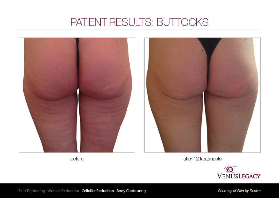 VLE__Before&After_023.jpg