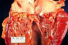 "Haemophilus parainfluenzae Endocarditis PHIL 851 lores" Licensed under Public domain via Wikimedia Commons