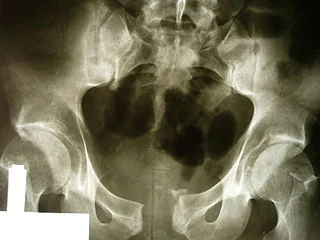Application of Pelvic Binders