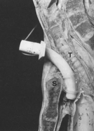 Trouble with Trachs - Recannulating the Stenosed Trach Site