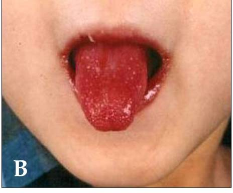 " Kawasaki symptoms B " by Kawasaki_symptoms.jpg : Dong Soo Kimderivative work: Natr ( talk ) - Kawasaki_symptoms.jpg . Licensed under CC BY 2.0 via Wikimedia Commons .
