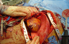" Emergency Thoracotomy " by Cothren and Moore; licensee BioMed Central Ltd. - http://www.ncbi.nlm.nih.gov/pmc/articles/PMC1459269/figure/F2/ . Licensed under CC BY 2.0 via Wikimedia Commons .