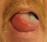 "Angioedema2013" by James Heilman, MD - Own work. Licensed under Creative Commons Attribution-Share Alike 3.0 via Wikimedia Commons - http://commons.wikimedia.org/wiki/File:Angioedema2013.JPG#mediaviewer/File:Angioedema2013.JPG