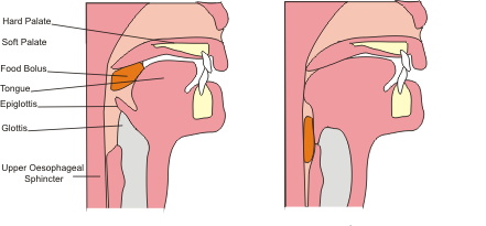 B Pod Case Reports: 22 Year Old with Difficulty Swallowing