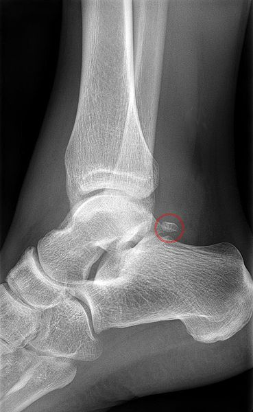 fractured ankle x ray