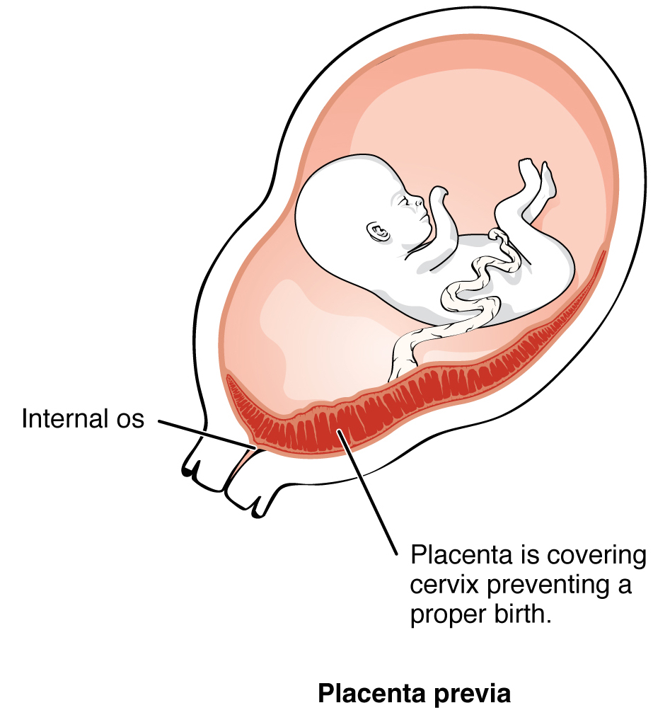 22 неделе плацента. Предлежание плаценты к передней стенке. Передняя стенка плаценты при беременности. Локализация плаценты передняя стенка. Переднее и заднее расположение плаценты при беременности.