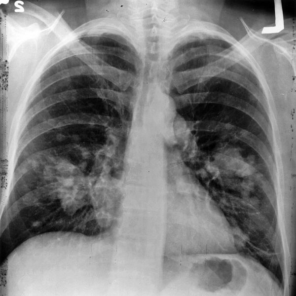 Hemoptysis — Taming the SRU