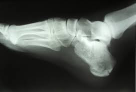 The Approach to the Foot X-ray