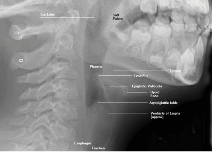 Soft Tissue Neck Radiographs