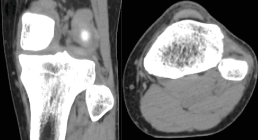 AP and Axial CT images showing an anterolateral fibular head dislocation