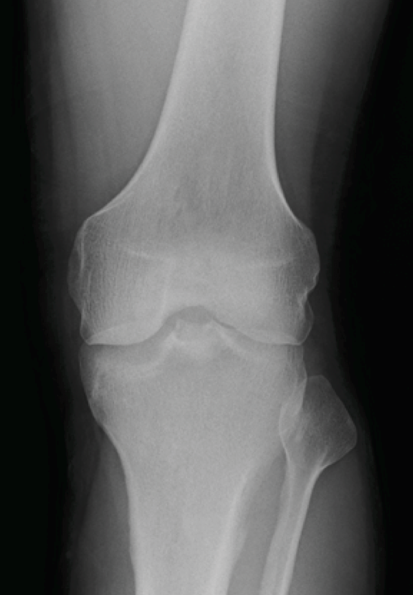 AP XRay of the left knee without obvious evidence of fracture or dislocation