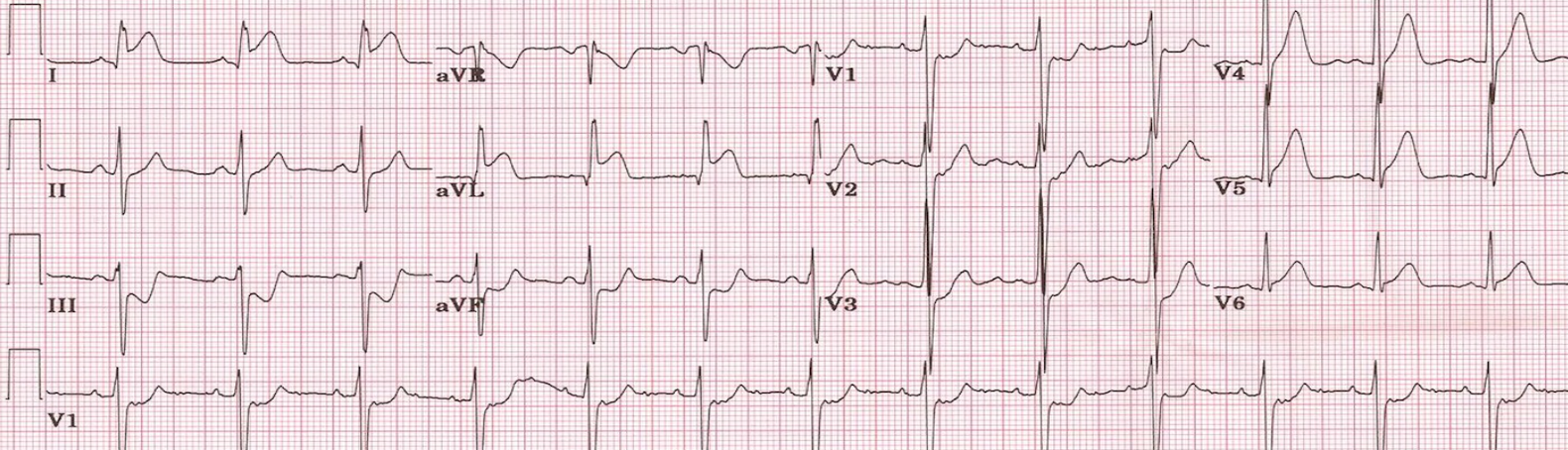 STEMI and STEMI Equivalents, i.e. Who Needs the Cath Lab Now! — Taming ...