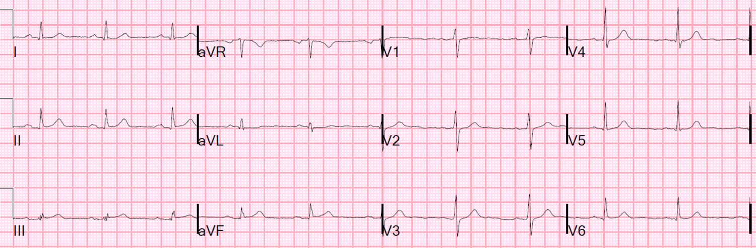Normal Stemi STEMI and STEMI Equivalents, i.e. Who Needs the Cath Lab Now! — Taming ...