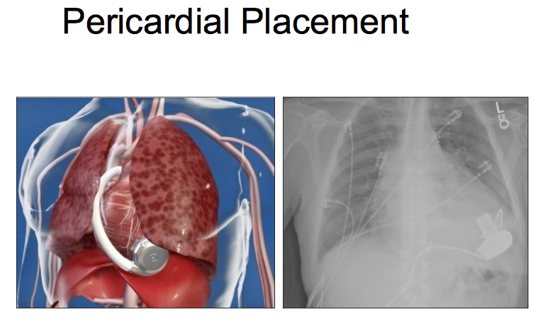 Pericardial placement of the HeartWare LVAD