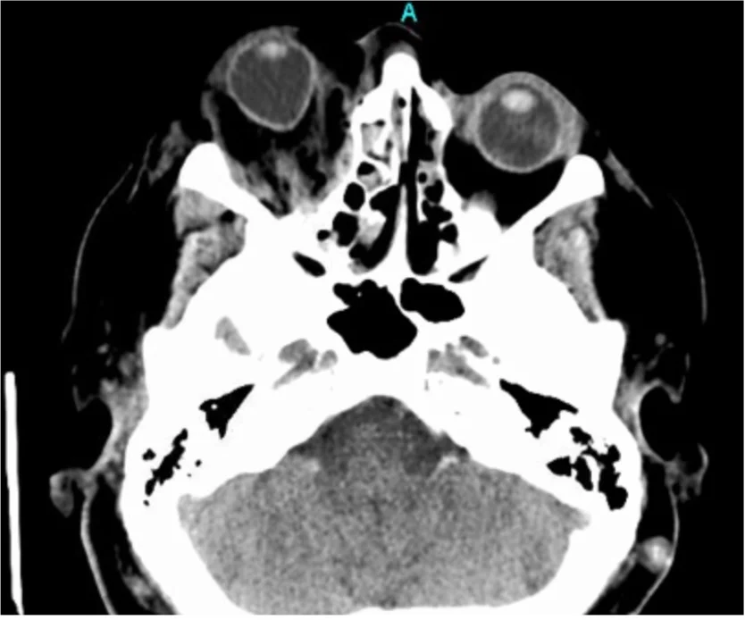 CT Maxillofacial without contrast. There is proptosis of the right eye, with teardrop sign as well as retro-orbital stranding consistent with blood in the orbital compartment