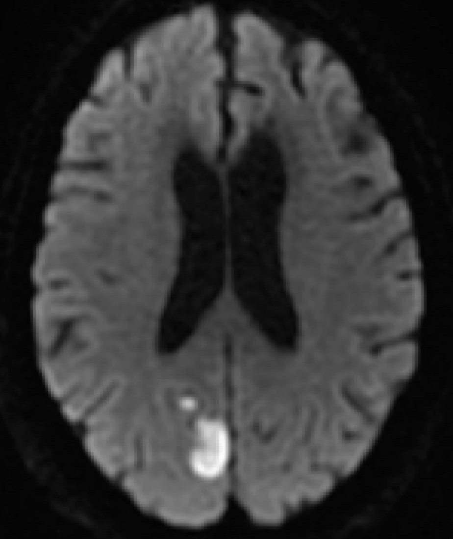 Figure 1. Diffusion weighted MRI of the brain without contrast. Acute ischemic infarct can be seen in the right occipital region.