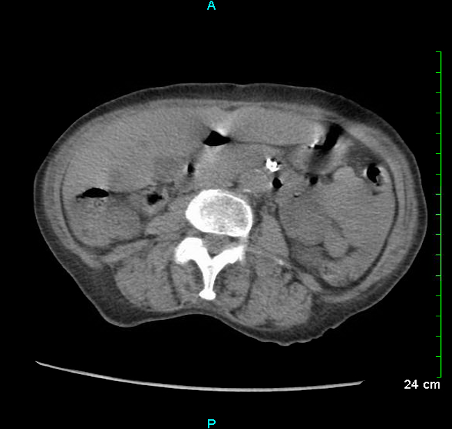 Markedly atherosclerotic SMA with flow limitation, in the context of transient hypotension of bacteremia cause non-occlusive ischemic colitis