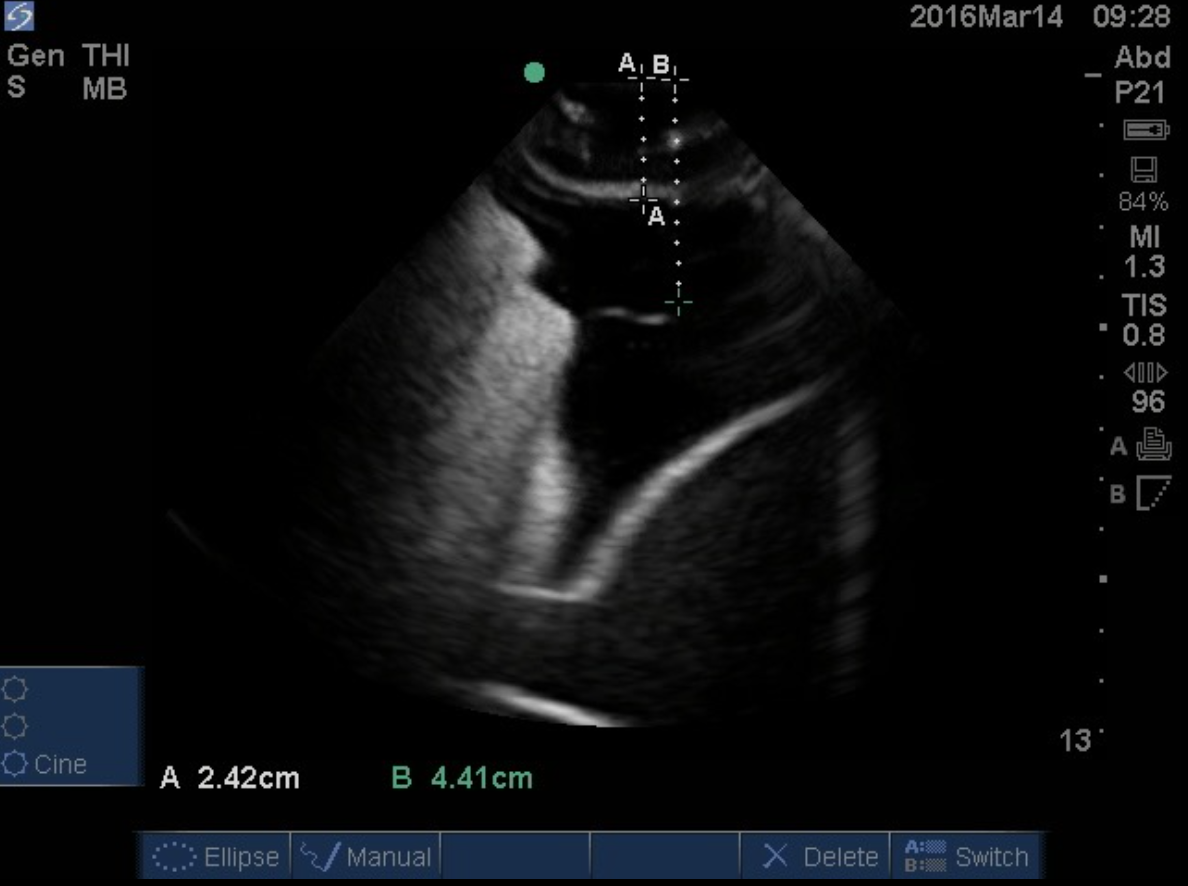 Thoracentesis Taming The SRU Thoracentesis Taming The SRU