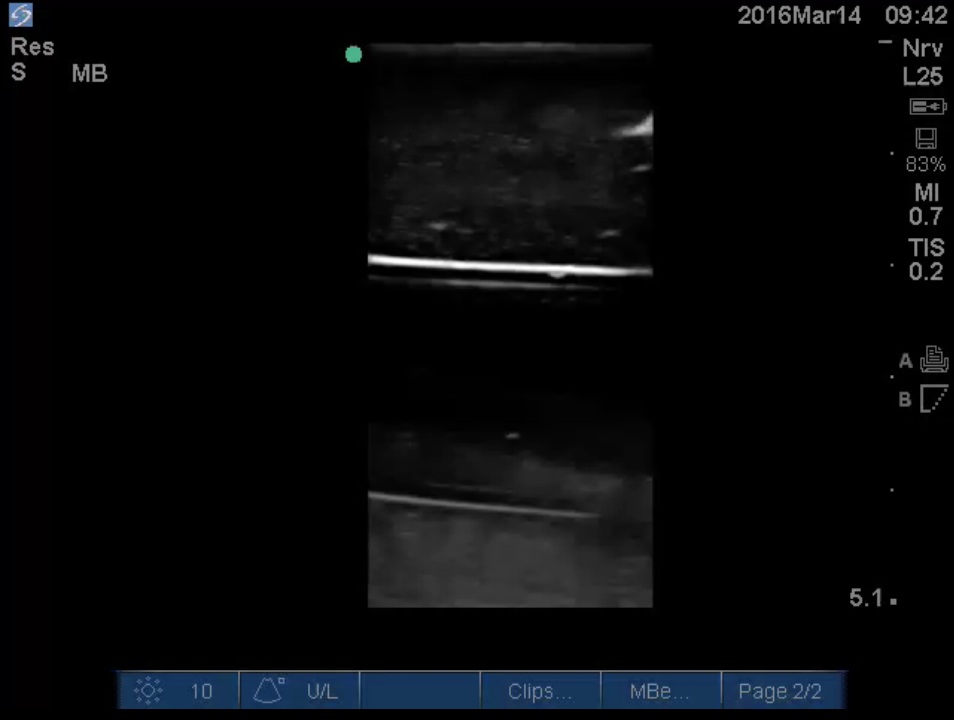 Thoracentesis Taming The SRU Thoracentesis Taming The SRU