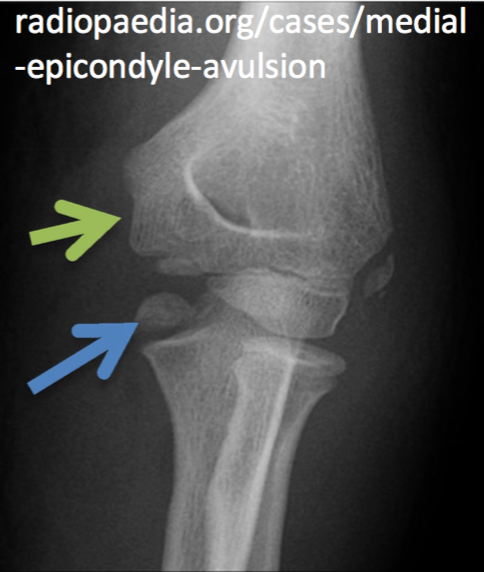 Interpreting Elbow And Forearm Radiographs Taming The Sru