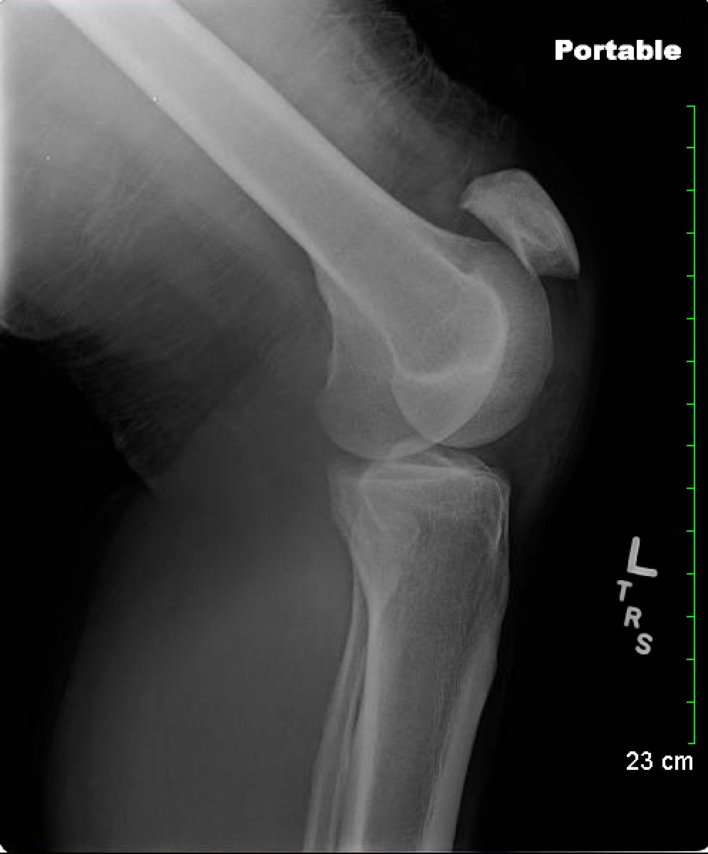 Figure 1: Xray of the left knee xray showing a high-riding patella.