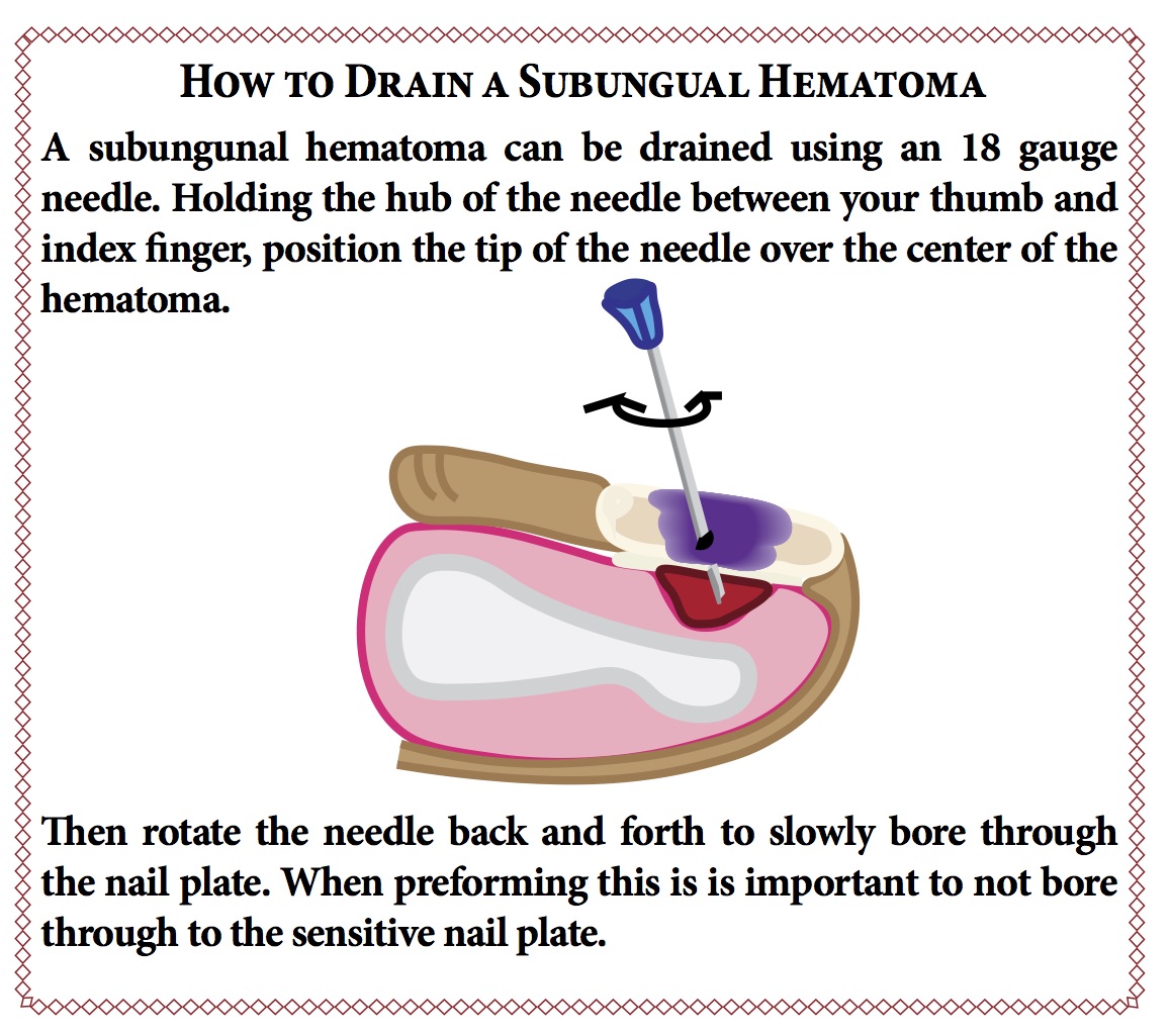 Nail Disorders | Plastic Surgery Key