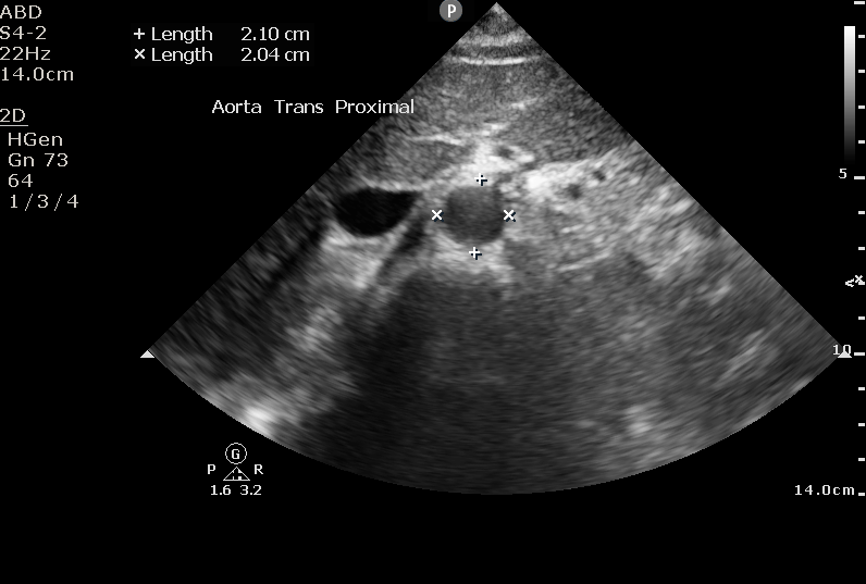 Aorta Ultrasound Taming The Sru