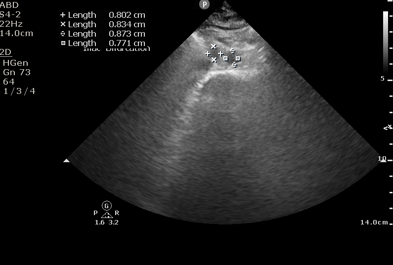 Aorta measurement at iliac arteries