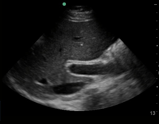 Transverse View of Gallbladder