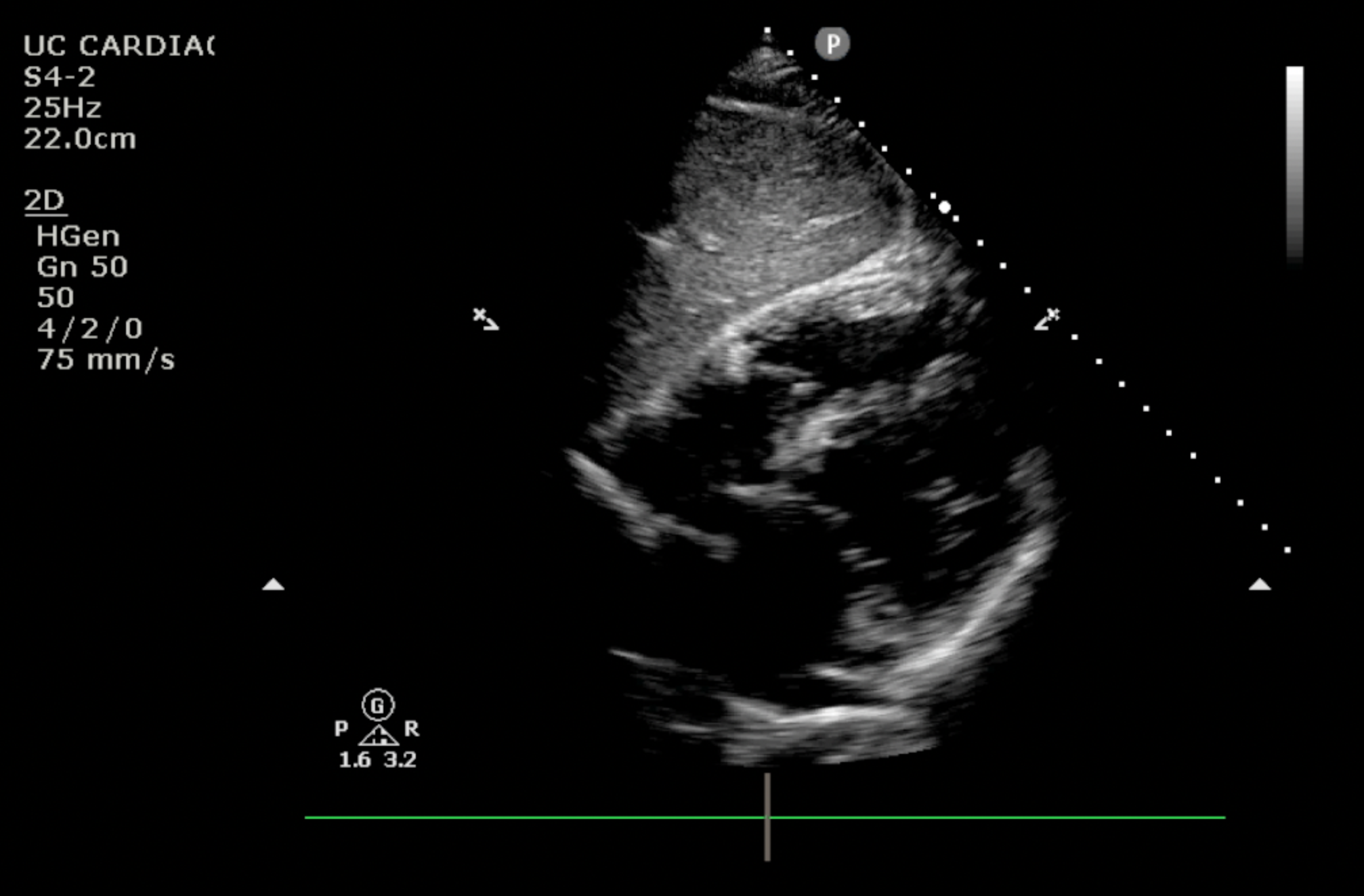 Sub-Costal view static image without pericardial effusion