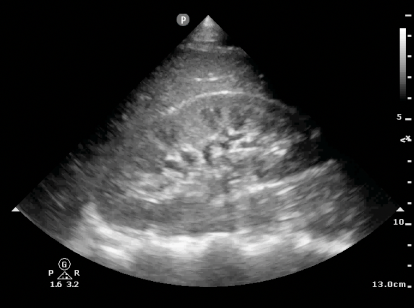 Static longitudinal image of kidney without hydronephrosis