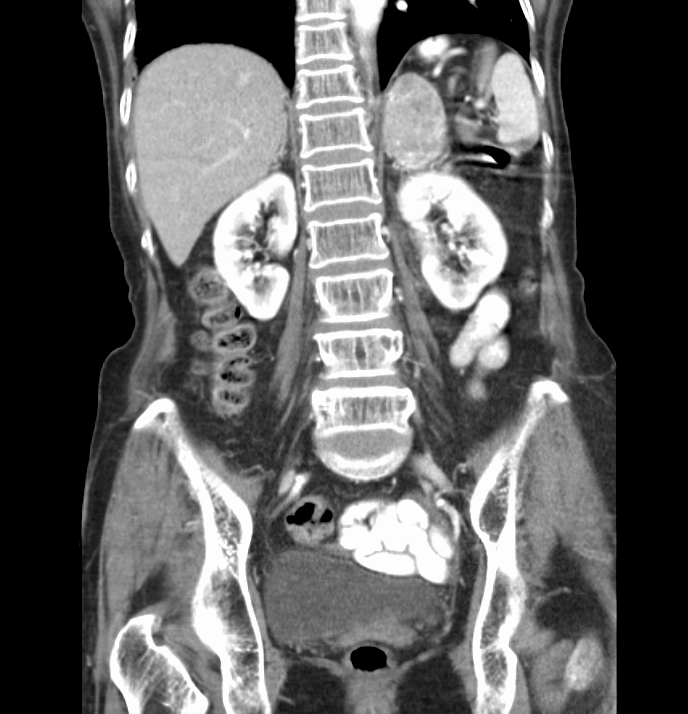 Annals of B-Pod: An Incidental Finding?