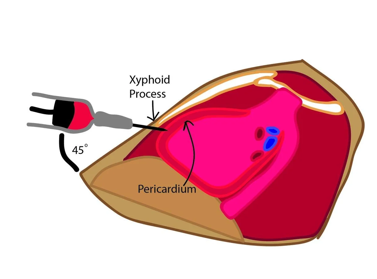 Annals of B Pod - B Pod Case: Taking Renal Failure to Heart