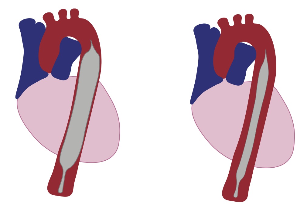 Annals of B-Pod: Intra-Aortic Balloon Pump
