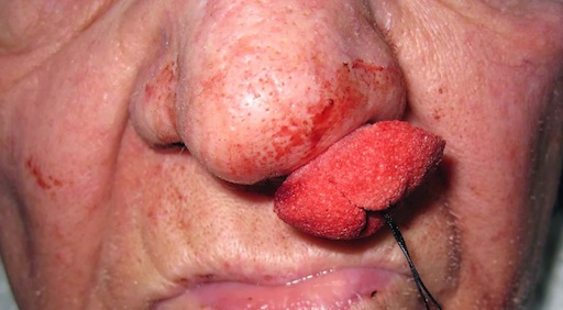 Do All Packed Noses Get Antibiotics?