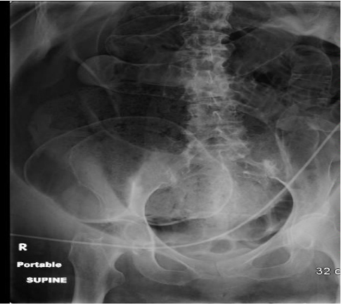 Annals of B-Pod: Abdominal Compartment Syndrome