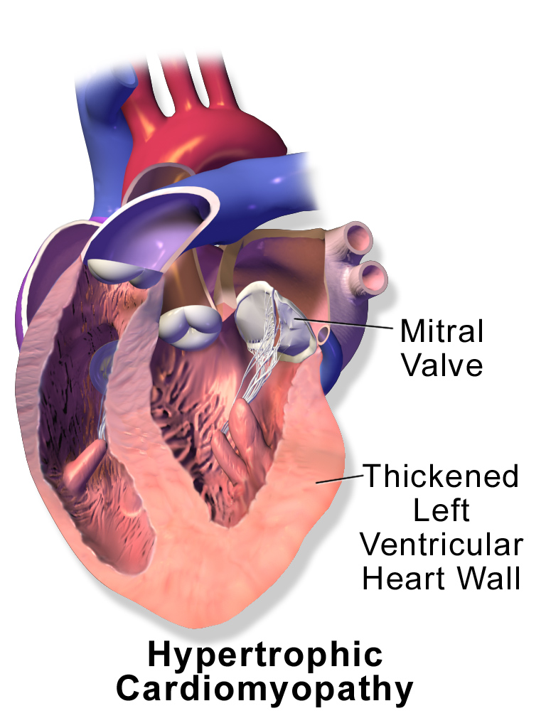 Blausen_0166_Cardiomyopathy_Hypertrophic.png