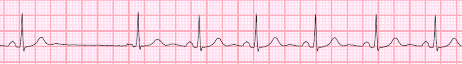 Heart Blocks: A Primer — Taming the SRU