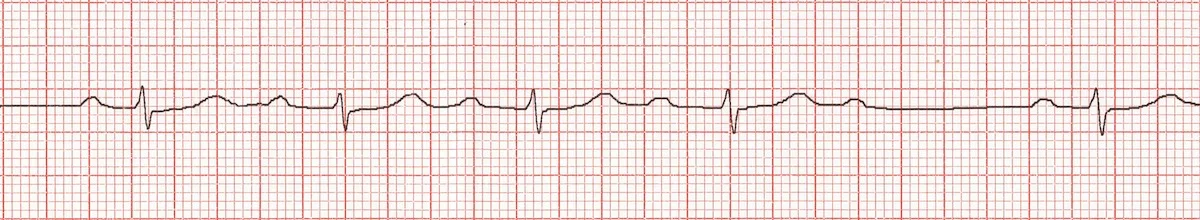 Heart Blocks: A Primer — Taming the SRU