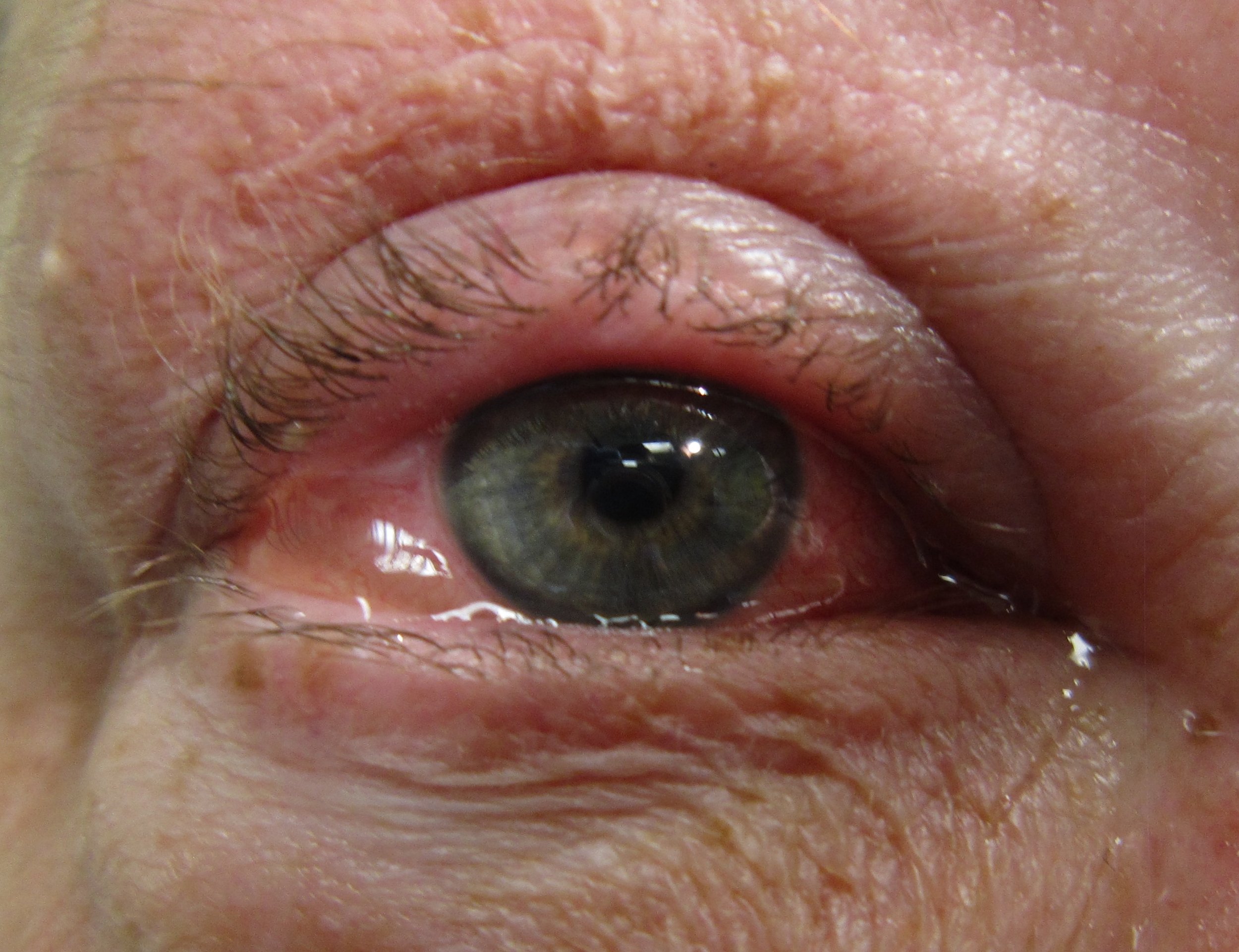 gonorrhea eye treatment