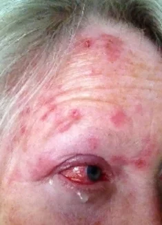 Conjunctivitis — Taming the SRU