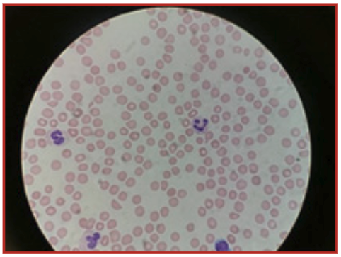 Annals of B-Pod: Thrombotic Thrombocytopenic Purpura