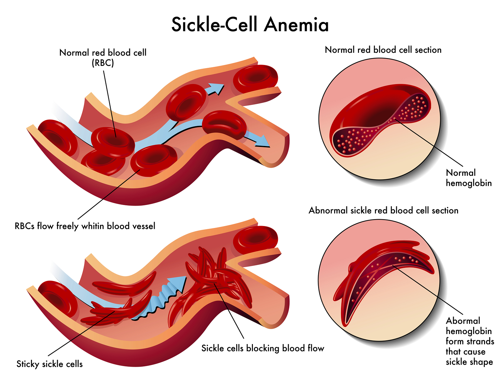 Hemoglobin Mutations Cause Sickle Cell Disease